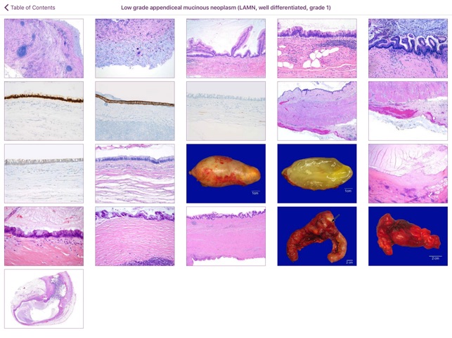 Appendiceal Pathology screenshot 2 of 6