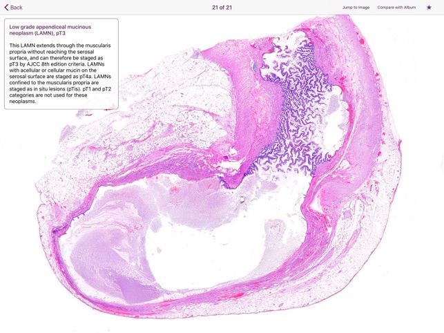 Appendiceal Pathology screenshot 3 of 6