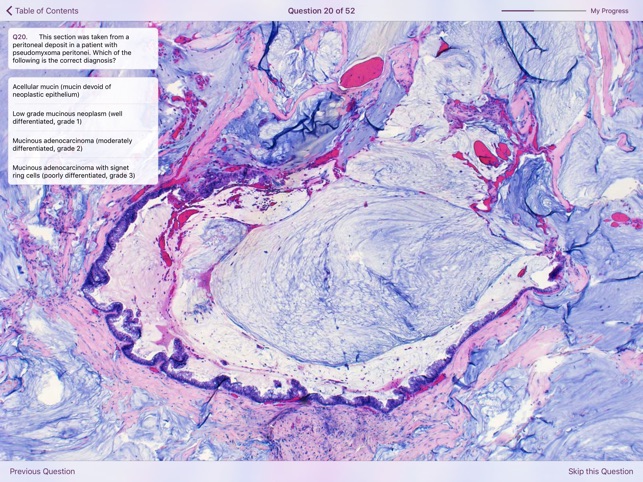 Appendiceal Pathology screenshot 4 of 6