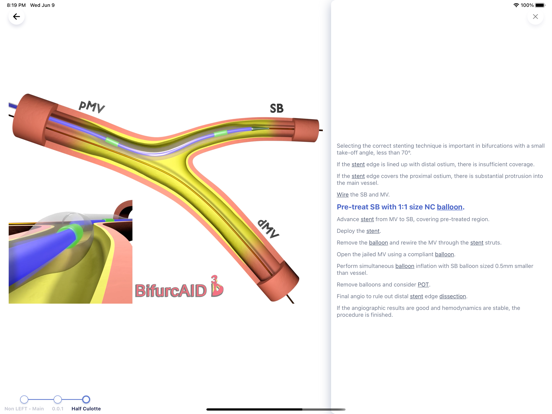 Bifurcaid 3D screenshot 8 of 20