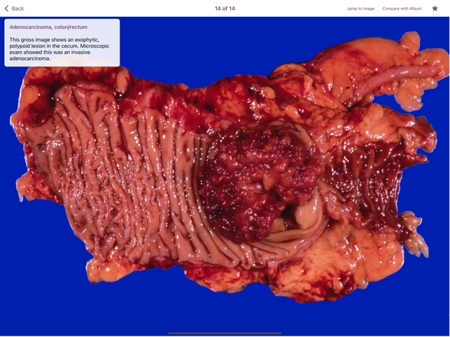 Colonic Pathology screenshot 3 of 6