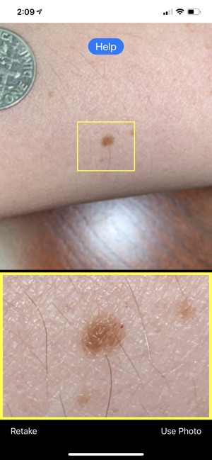 Mole Mapper Melanoma Study screenshot 4 of 8
