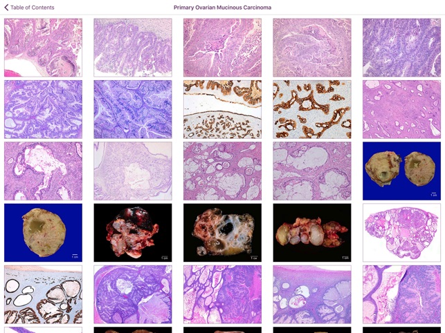 Ovarian Tumor Pathology screenshot 2 of 5