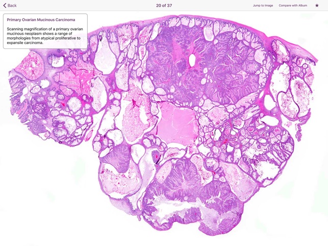 Ovarian Tumor Pathology screenshot 3 of 5