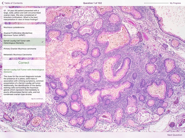 Ovarian Tumor Pathology screenshot 5 of 5