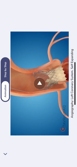 TAVRcathAID screenshot 7 of 10